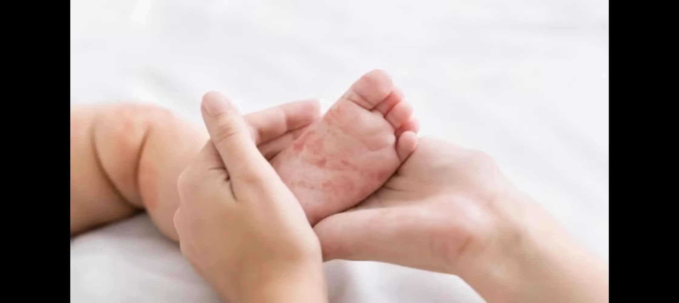 Measles deaths jumped by over 40% in 2022 globally: WHO